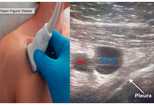 ICS_updates's tweet photo. Online first from the Journal of Intensive Care Society #journalics:
Cannulation of the subclavian vein using real time ultrasound guidance
https://t.co/64x1V5w70j
#POCUS #ultrasound #foamed #FOAMcc
(note that this is within our #FUSIC syllabus) https://t.co/ZpTPhph15x