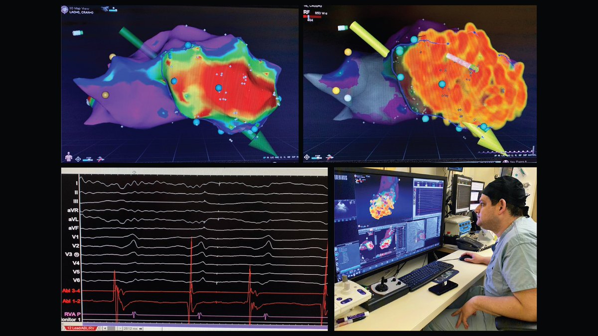JeffNeiger's tweet photo. Ischemic VT- Large mid to apical scar homgenization achieved quickly with #stereotaxis #RMT #biosensewebster https://t.co/UgNVHdU5u1