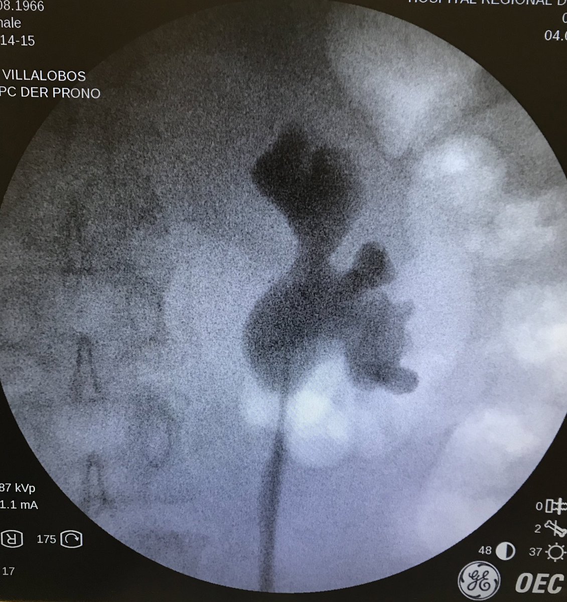 JE_Espinosa88's tweet photo. #Caseoftoday: Right kidney #stone. #PCNL w/prone position. Bull’s eye fluoroscopy guided access. #stonefree rate. Ft. MD. Miguel Villalobos and endourology fellow @juanjoselascano
Tip: Don’t married w/ just one technique ✍🏻
#Urology #HRAEPY #UroSoMe https://t.co/8wOjBwZ7bR