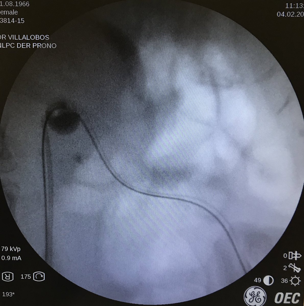 JE_Espinosa88's tweet photo. #Caseoftoday: Right kidney #stone. #PCNL w/prone position. Bull’s eye fluoroscopy guided access. #stonefree rate. Ft. MD. Miguel Villalobos and endourology fellow @juanjoselascano
Tip: Don’t married w/ just one technique ✍🏻
#Urology #HRAEPY #UroSoMe https://t.co/8wOjBwZ7bR
