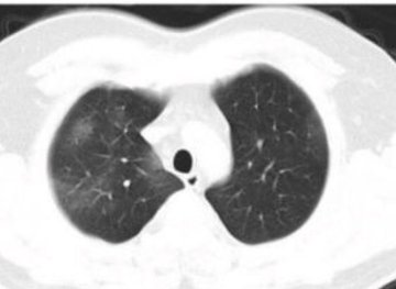 coronavirus 2019-nCoV, lungs.