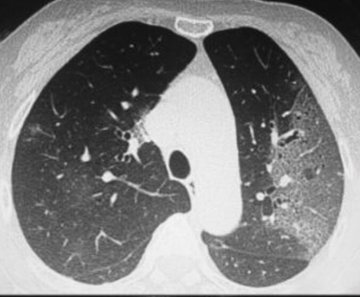 Coronavirus 2019-nCoV, lungs image 1.