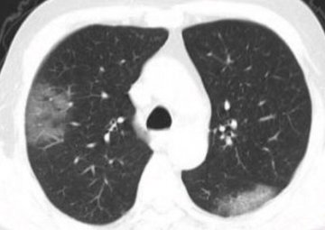 Coronavirus 2019-nCoV, lungs image 1.