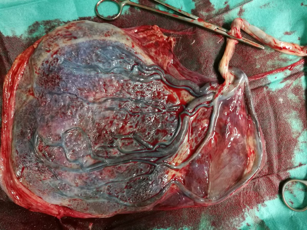 LucreziaMD's tweet image. Vasa praevia, diagnosed at 1st stage of labor (4 cm dilated). I performed emergency CS. Then we diagnosed velamentous cord insertion. #obstetrics #obgyn #vasapraevia #velamenouscordinsertion #cesarean #lucky