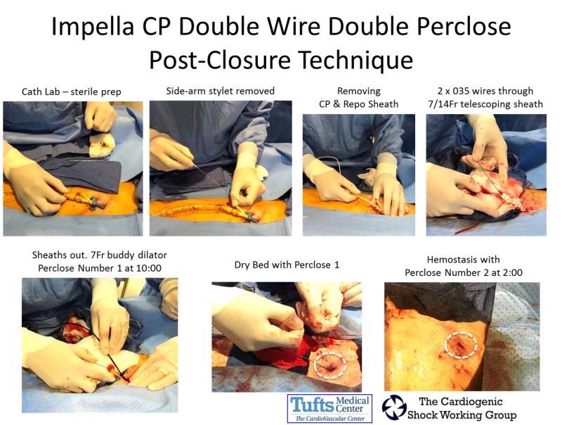 HadyLichaaMD's tweet image. Slick #Cathlabhack: Innovative technique by @TuftsMedicalCtr to close #impella access w/o pre-closure during CS. Less delay for #door_2_unload time &amp;amp; no more need to worry about the sterility of preclose sutures in ICU! #ICTweeters #NCSI #ACCIC #cardiotwitter @ACCinTouch @SCAI
