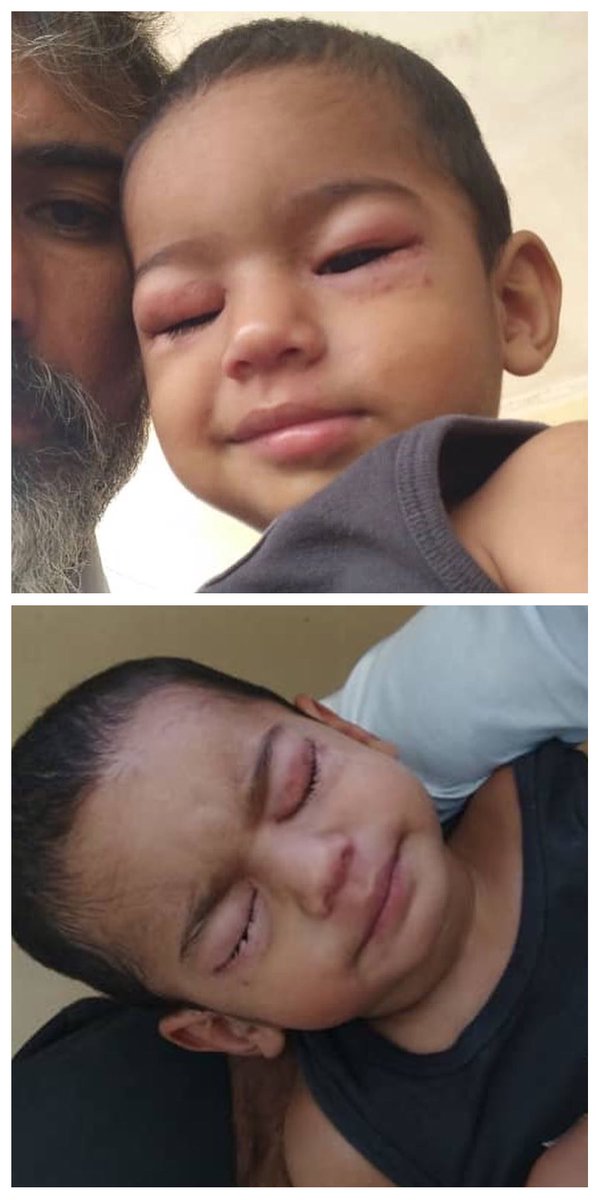 Craig_Foster's tweet photo. My little mate Cyrus. Constantly sick in Moresby from inadequate nutrition, living conditions and medical care. Can’t crawl or walk without surgery. It’s a disgrace. End it. Get everyone to safety. Hang in there little buddy ❤️❤️ #GameOver 👉 https://t.co/pCEHKJZMOk https://t.co/mxPVkZKeOK