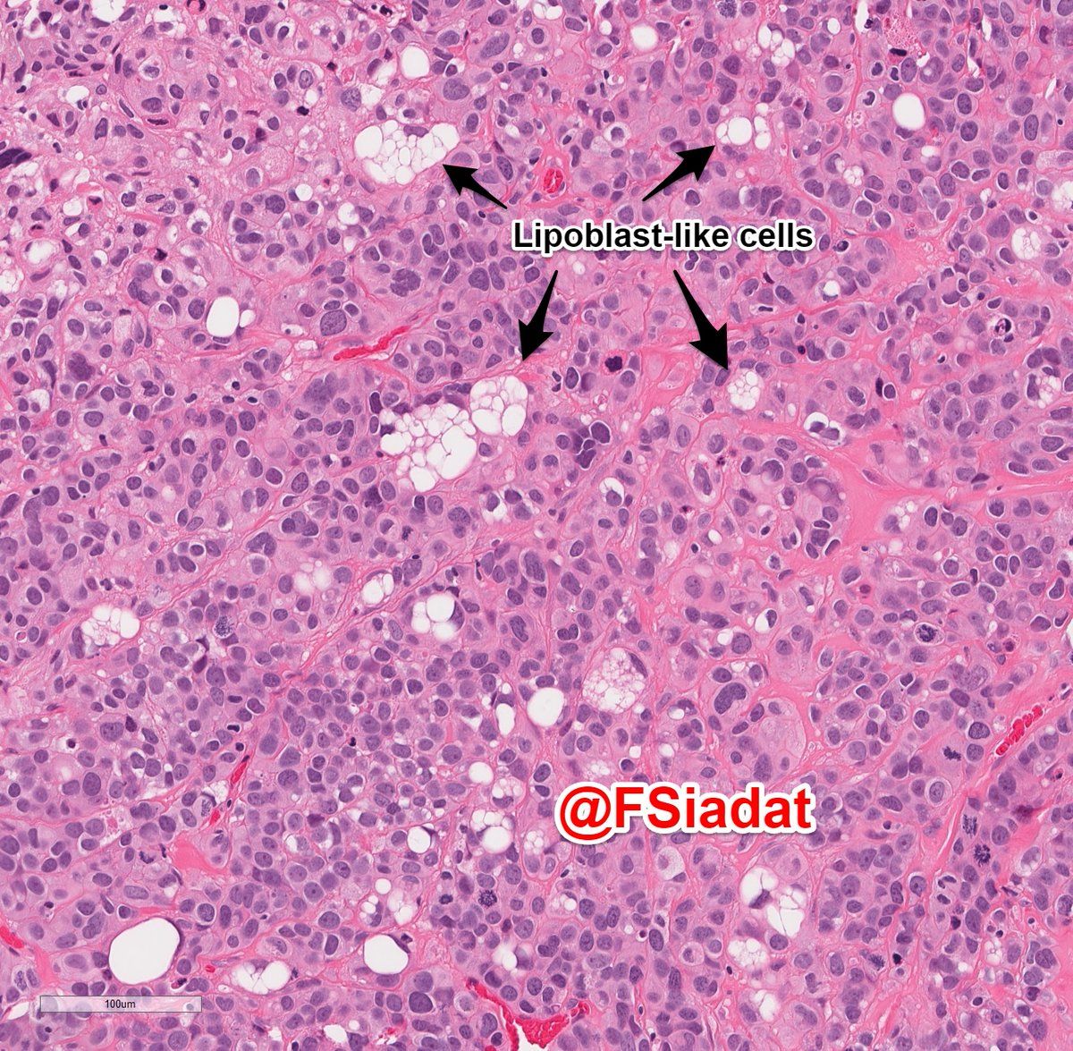 FSiadat's tweet photo. Lipid-rich urothelial carcinoma. It is a rare and high grade variant with large lipoblast-like cells with cytoplasmic vacuoles indenting the nuclei. 

#gupath #pathology #Bladdercancer https://t.co/m2EJUat5qI