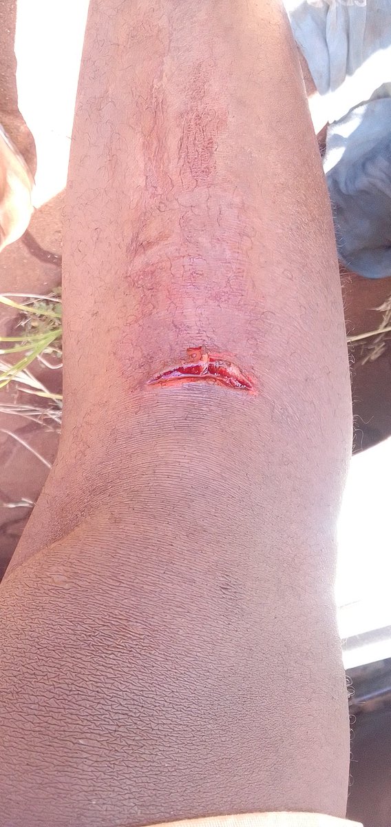 mduh074's tweet photo. I have seen things in my life but the pain I had yesterday while grind cutting disc nearly chop my leg off https://t.co/3w4UMZfNPF