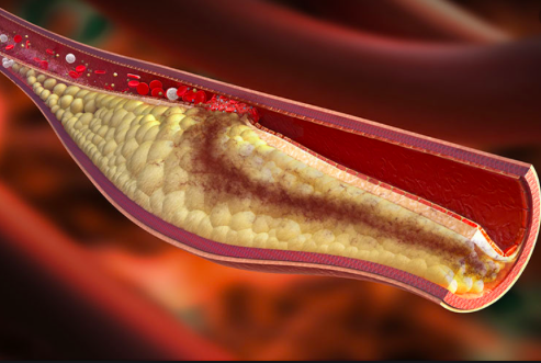 SIAC_cardio's tweet photo. Consejo #CardioSIAC
Un enfoque diferente hacia la enf. coronaria
3 conceptos puestos en duda:
-La isquemia inducible⏩mal pronóstico
-Lesión coronaria severa⏩Objetivo en coronarios estables
-Detección de placa vulnerable⏩poco útil
Editorial Dr. Elvis Rivera y Cesar Herrera 🇩🇴 https://t.co/iH5B5KK3e7