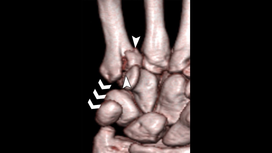 RadioGraphics (@radiographics) on Twitter photo Avulsions of the hand & wrist often have a characteristic imaging appearance that relates to the intricate bone and soft-tissue anatomy, dictating the treatment options for patients with these injuries. bit.ly/2tLsFBm <a href="/UofURadiology/">UofURadiology</a> <a href="/MskUtah/">Utah MSK Rads</a> <a href="/UofUMedicine/">Spencer Fox Eccles School of Medicine</a> <a href="/UofUHealth/">University of Utah Health</a> Avulsions of the hand & wrist often have a characteristic imaging appearance that relates to the intricate bone and soft-tissue anatomy, dictating the treatment options for patients with these injuries. bit.ly/2tLsFBm <a href="/UofURadiology/">UofURadiology</a> <a href="/MskUtah/">Utah MSK Rads</a> <a href="/UofUMedicine/">Spencer Fox Eccles School of Medicine</a> <a href="/UofUHealth/">University of Utah Health</a>