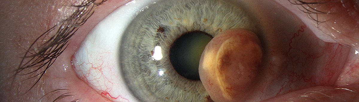 J William Harbour MD (@jwharbourmd) on Twitter photo Read my latest #research on uveal melanoma single cell analysis, published with <a href="/SpringerNature/">Springer Nature</a> in <a href="/NatureComms/">Nature Communications</a>. Read and share here: rdcu.be/b0IGC.
<a href="/BascomPalmerEye/">Bascom Palmer Eye Institute</a> <a href="/SylvesterCancer/">Sylvester Comprehensive Cancer Center</a> #cancer #melanoma #uvealmelanoma #ocularoncology Read my latest #research on uveal melanoma single cell analysis, published with <a href="/SpringerNature/">Springer Nature</a> in <a href="/NatureComms/">Nature Communications</a>. Read and share here: rdcu.be/b0IGC.
<a href="/BascomPalmerEye/">Bascom Palmer Eye Institute</a> <a href="/SylvesterCancer/">Sylvester Comprehensive Cancer Center</a> #cancer #melanoma #uvealmelanoma #ocularoncology