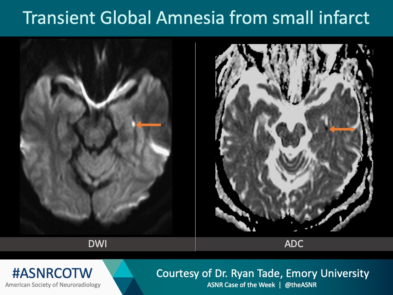 Transient Global Amnesia The Long Term Risk Of Dementia After