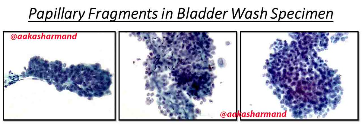 aakasharmand's tweet photo. @ParisSystem2 @eva_wojcik @barkanga @marcoslepe @twmarkc @pembeoltulu @PennPathLabMed @DiagnosticCyto @JASCJOURNAL @kriyer68 @sam_albadri https://t.co/tPHFIkgRLi