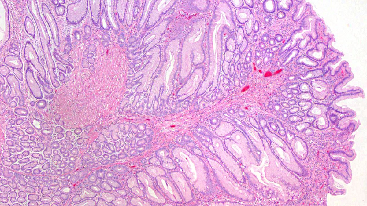 JosephMisdraji's tweet photo. You don't know JACK! 22 yo man with polyps in stomach and colon. Since 2014, has had a few more similar polyps. Syndrome, please?  While you ponder this, I will review his history to give you a clue when you give up....and you will give up. https://t.co/LzdHrv1lBP