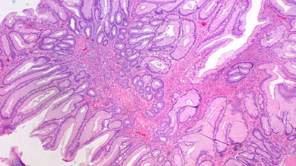 JosephMisdraji's tweet photo. You don't know JACK! 22 yo man with polyps in stomach and colon. Since 2014, has had a few more similar polyps. Syndrome, please?  While you ponder this, I will review his history to give you a clue when you give up....and you will give up. https://t.co/LzdHrv1lBP