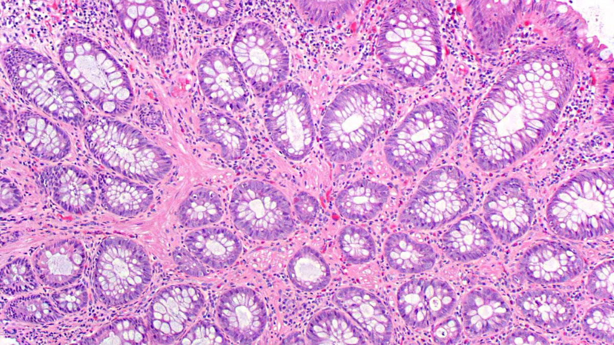 JosephMisdraji's tweet photo. You don't know JACK! 22 yo man with polyps in stomach and colon. Since 2014, has had a few more similar polyps. Syndrome, please?  While you ponder this, I will review his history to give you a clue when you give up....and you will give up. https://t.co/LzdHrv1lBP