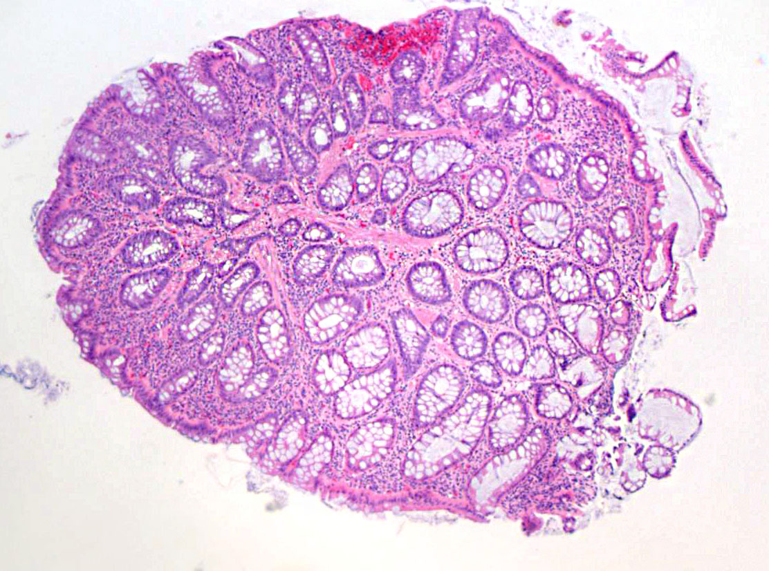 JosephMisdraji's tweet photo. You don't know JACK! 22 yo man with polyps in stomach and colon. Since 2014, has had a few more similar polyps. Syndrome, please?  While you ponder this, I will review his history to give you a clue when you give up....and you will give up. https://t.co/LzdHrv1lBP