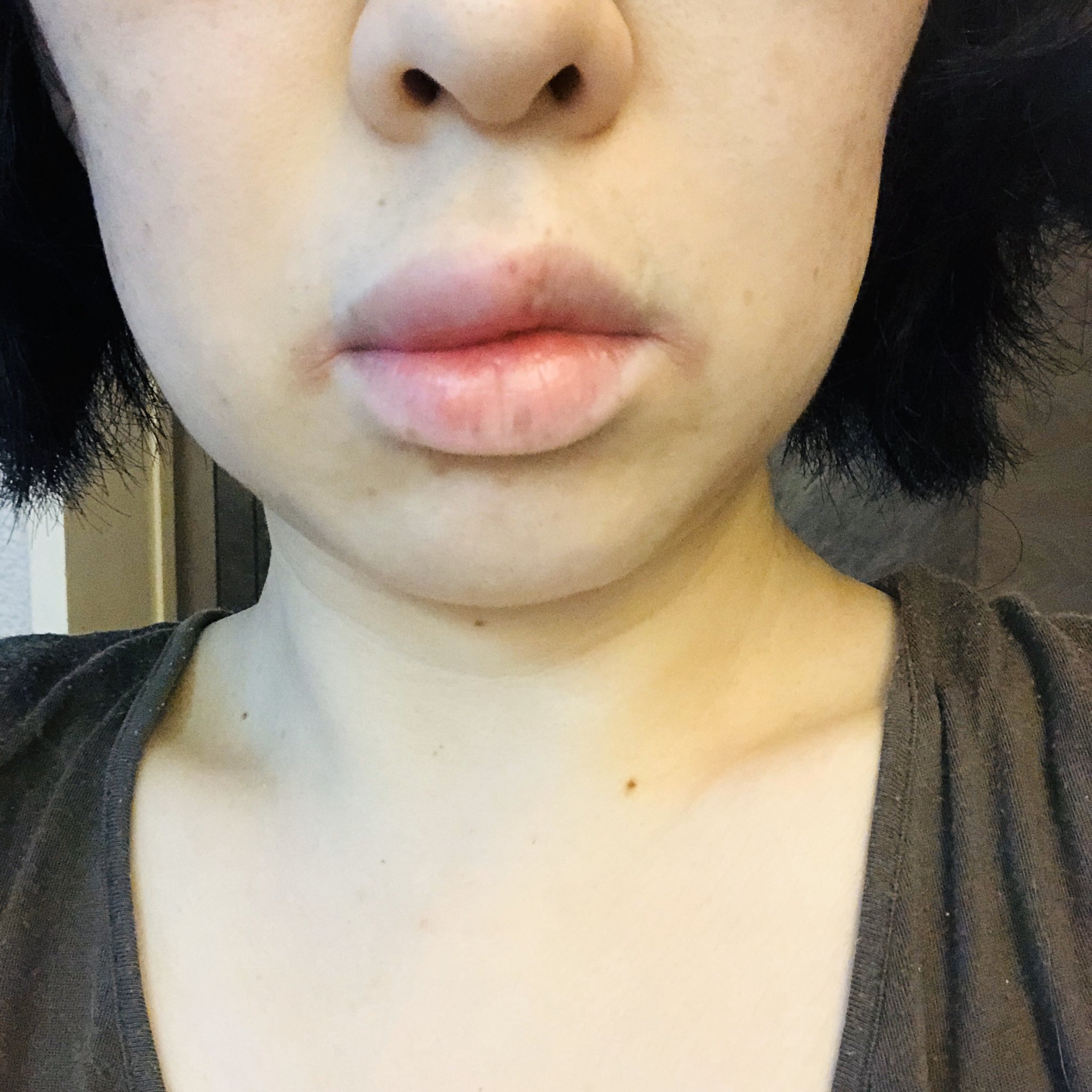 Sato Mayumi Sur Twitter 朝起きたら 上唇の右側だけが大きく腫れ ていて まるで歯医者で注射されて麻酔かけられたようになってた 旧正月前に歯医者で麻酔したばかりなのでまるで同じ感覚 もしかしてアレルギー 唇が腫れた アレルギーで唇は腫れるか T