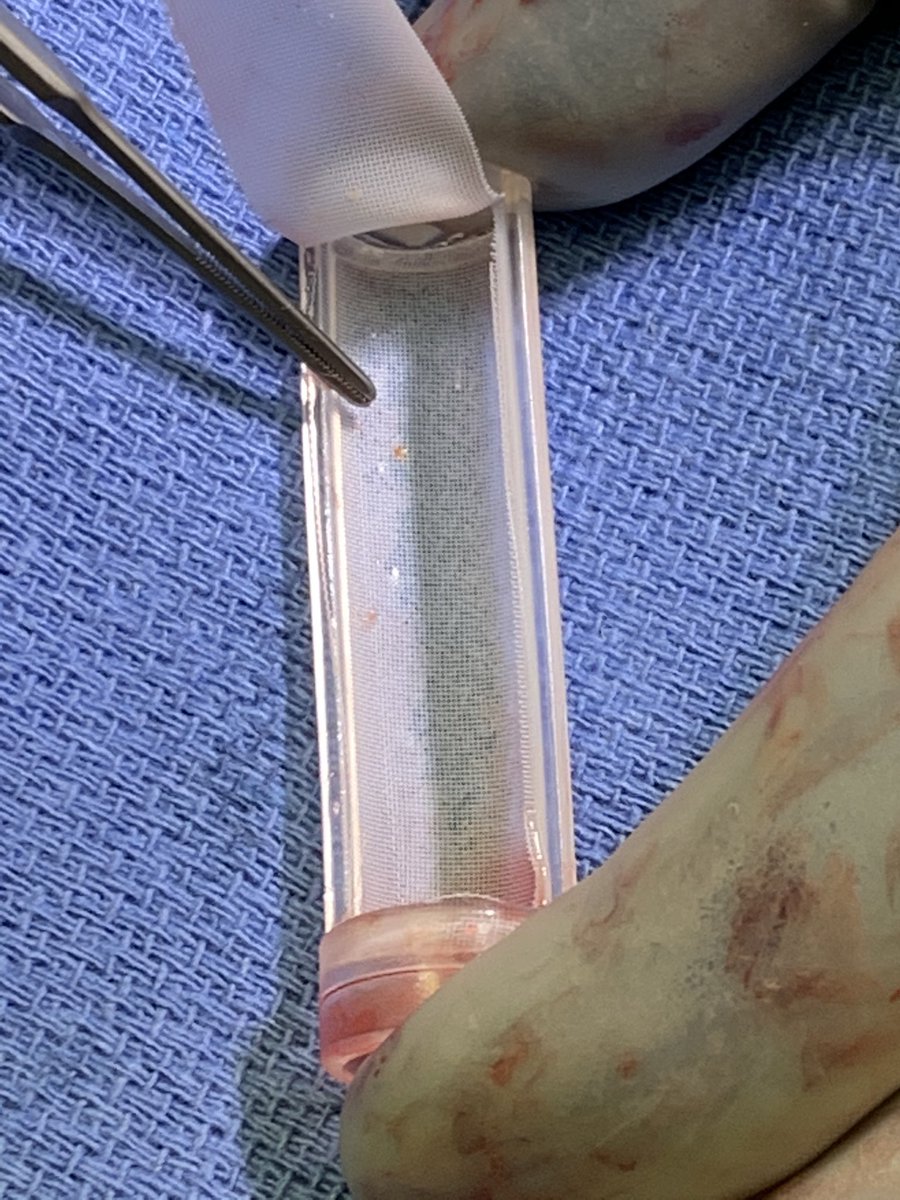 mattsmeds's tweet photo. Another successful @SLUVascular #tcar. Forceps pointing out the power of #flowreversal @SilkRoadMed https://t.co/C5sALQwp4K