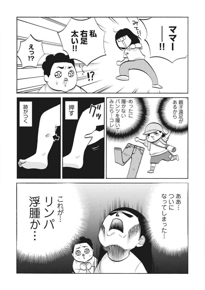 今月のさよしきゅそのあとは5、6話目が入ってます!ずっと描きたかったリンパ浮腫の話ですー!
さよならしきゅう そのあと プチキス(3) (Kissコミックス) 講談社  @amazonJPから 