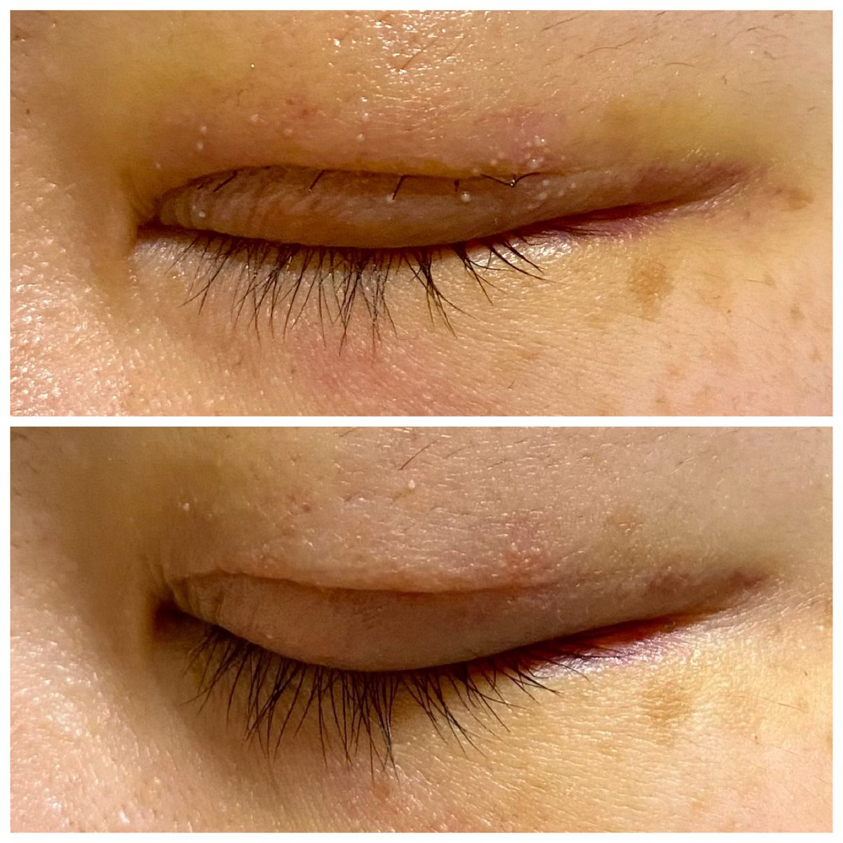 2号ちゃん 全切開dt 番外編 4日目夕方 切開ライン付近に大量の白いプツプツを発見 稗粒腫 白ニキビ って焦ったけど 抜糸時に聞いたら洗顔料使って洗ったら消えてくよって言われて一安心 下の写真が6日目夕方 この調子ならとりあえず大丈夫そう