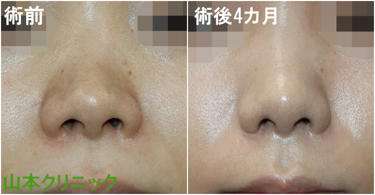 公式 山本クリニック 他院修正 小鼻縮小 です 前医で小鼻縮小を受け もう少し小さく小さく したいというご希望があり当院にて修正手術を行いました 小鼻の丸みを損なうことなくサイズ感がもう少し小さくなったかと思います 術後の傷も時間と共に