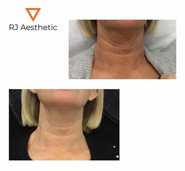 rjaesthetic's tweet photo. Wow.. Amazing results from #3d #hifu. Just ONE month on.. Full effects to be seen 3 months on.. #hifu #3dhifu #nonsurgicalfacelift #3dlipo #3dhifu #wrinkles #finelines #facelift #hifumachine #lipohifu #agingskin https://t.co/gSJ0zNNMKG https://t.co/AU3aqfTBGX