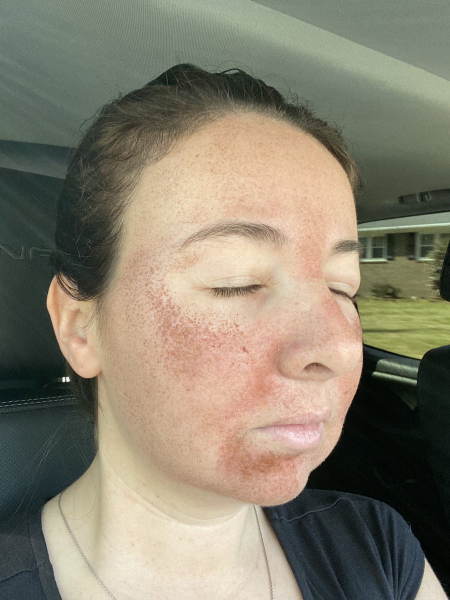 ncsulilwolf's tweet photo. #HaloLaser @azuraskin Post Treatment Day 3
Much less swelling, save for around the eyes, and lots of drying, flaking, and man... itchiness. I can’t wait for @Jenkpac to give me the green light to moisturize!
@sciton https://t.co/z1eqOKhfkm