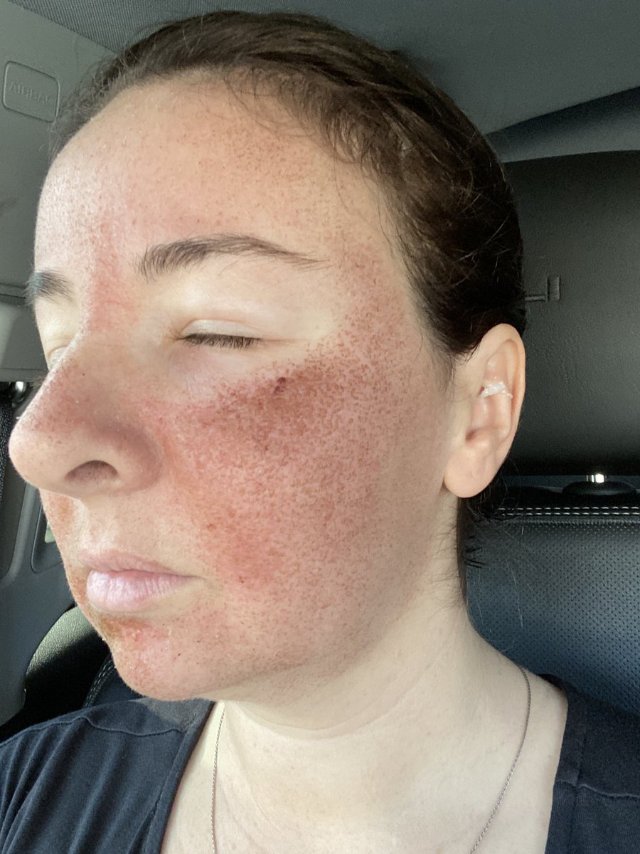 ncsulilwolf's tweet photo. #HaloLaser @azuraskin Post Treatment Day 3
Much less swelling, save for around the eyes, and lots of drying, flaking, and man... itchiness. I can’t wait for @Jenkpac to give me the green light to moisturize!
@sciton https://t.co/z1eqOKhfkm