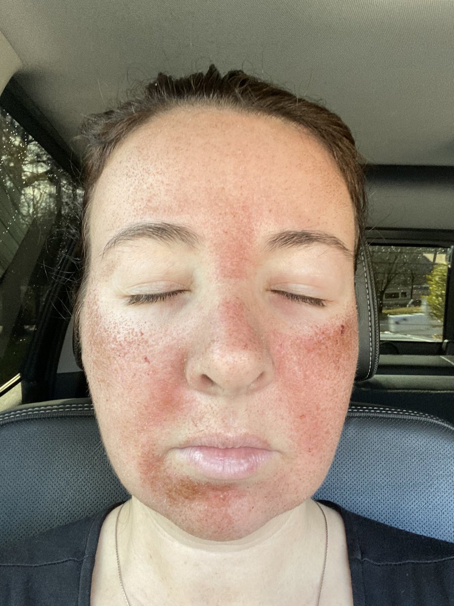 ncsulilwolf's tweet photo. #HaloLaser @azuraskin Post Treatment Day 3
Much less swelling, save for around the eyes, and lots of drying, flaking, and man... itchiness. I can’t wait for @Jenkpac to give me the green light to moisturize!
@sciton https://t.co/z1eqOKhfkm