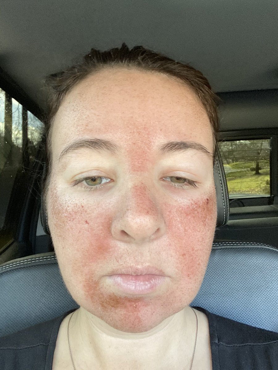 ncsulilwolf's tweet photo. #HaloLaser @azuraskin Post Treatment Day 3
Much less swelling, save for around the eyes, and lots of drying, flaking, and man... itchiness. I can’t wait for @Jenkpac to give me the green light to moisturize!
@sciton https://t.co/z1eqOKhfkm
