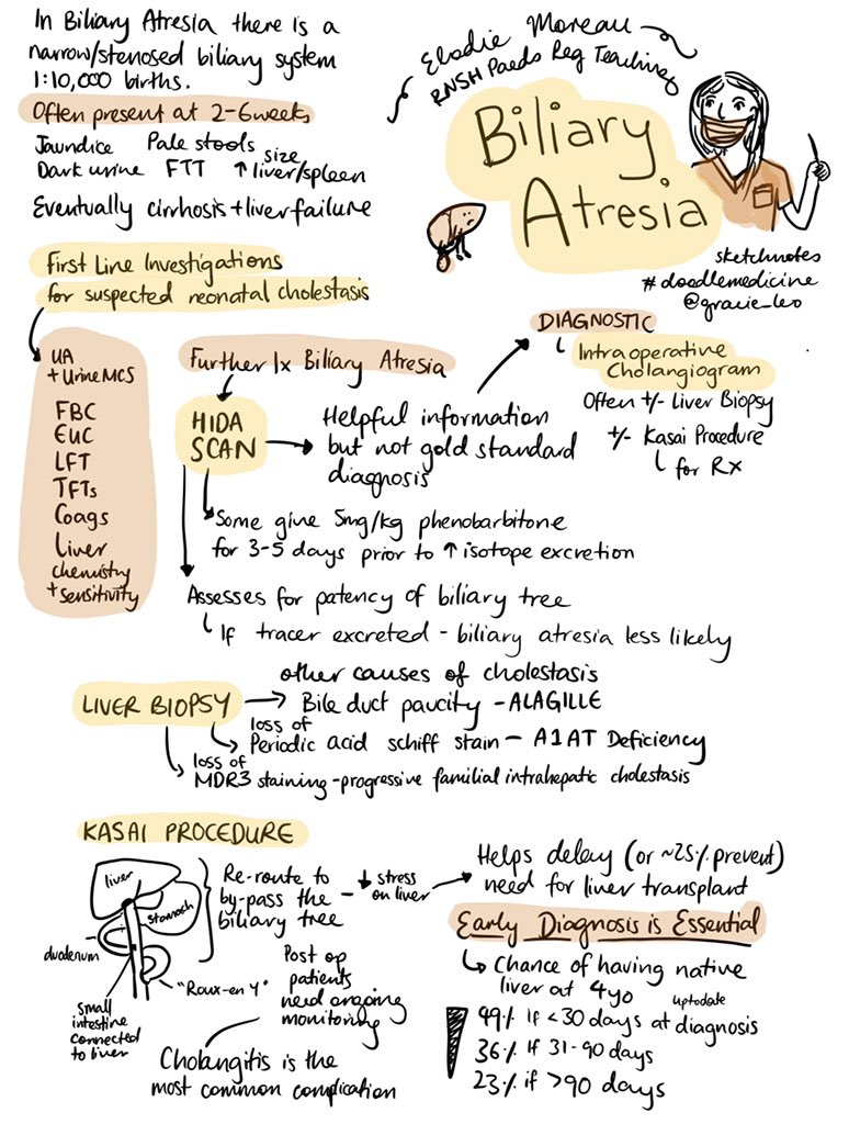 gracie_leo's tweet image. Did you know that children diagnosed with biliary atresia before 1 month of age are twice as likely to still have their native liver at 4 years of age compared to diagnosis after 3 months?

Here’s a #doodlemedicine summary of some key pointers #FOAMped #paediatricteaching