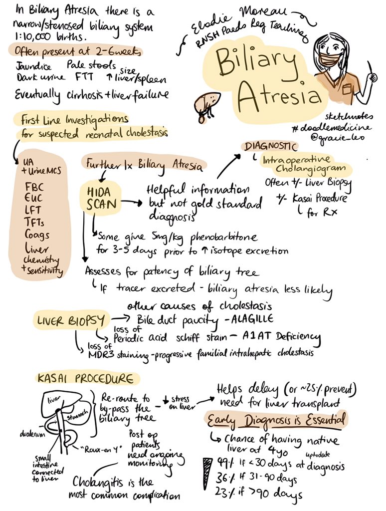 Did you know that children diagnosed with biliary atresia before 1 month of age are twice as likely to still have their native liver at 4 years of age compared to diagnosis after 3 months?

Here’s a #doodlemedicine summary of some key pointers #FOAMped #paediatricteaching