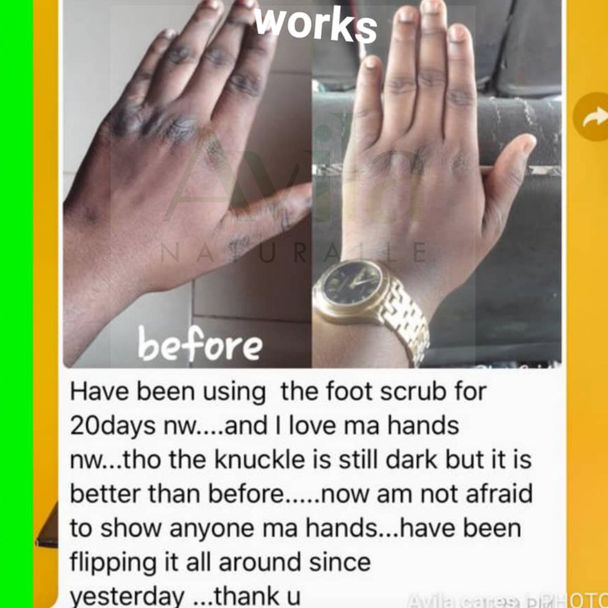 AvilaNaturalle's tweet photo. AVILA NATURALLE DARK KNUCKLES REMEDY SET.
This set is a careful selection of 100% natural products which will not peel your skin but gradually fade off those difficult dark areas of the knuckles,kneecap,ankles and toes with consistent use.
#darkknuckles #dollypartonchallenge https://t.co/7v4UIplWC1