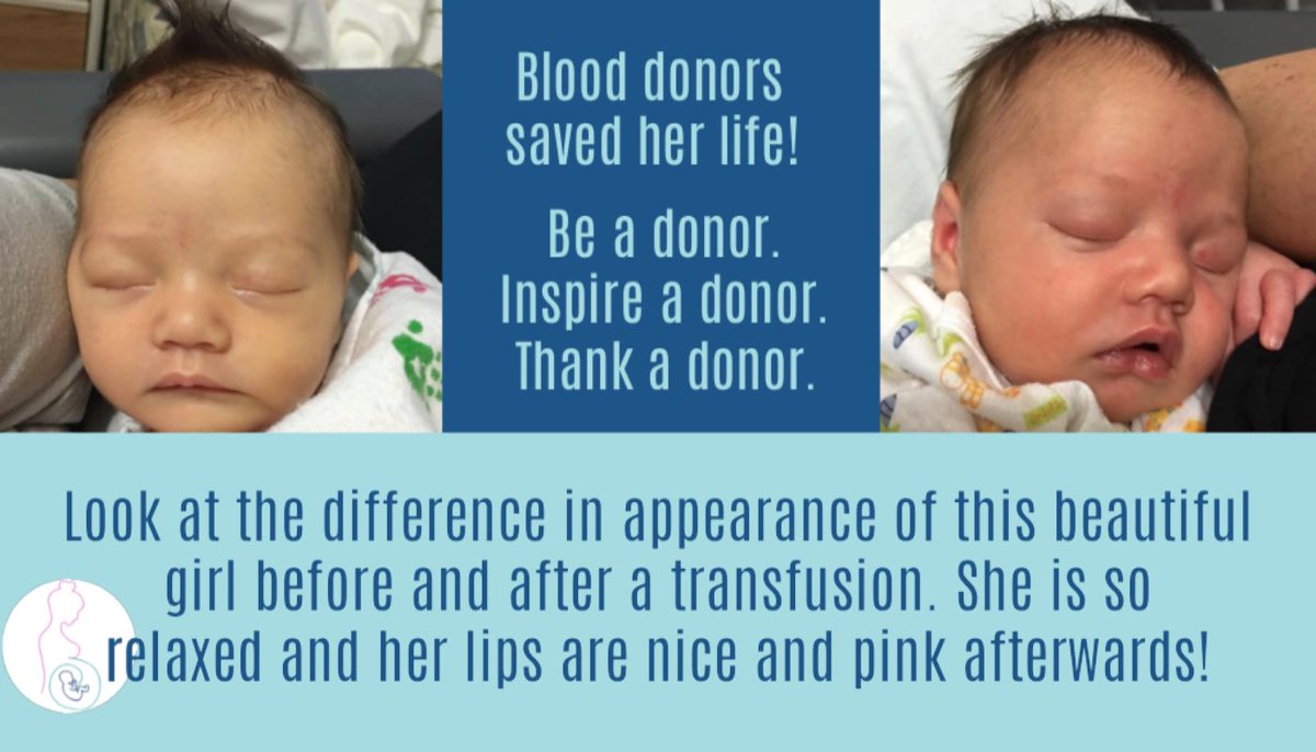 allofound's tweet photo. Isn’t the difference in her color amazing? #Blooddonors saved her from #anemia caused by #HDFN January isn’t over- be a hero during #NationalBloodDonorMonth and #donateblood #savelives #alloimmunization #antic #isoimmunization #antiD #rhdisease #nicu #hdfn #maternalhealth https://t.co/NBSpW6HvLV