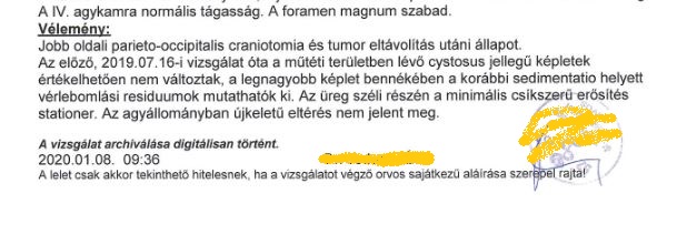 Zsófia Clemens, PhD (@clemenszsofia) on Twitter photo GOOD NEWS ON OUR GLIOBLASTOMA PATIENT
New MRI again confirmed no progression. Currently, he has:
👉 48 months overall survival
👉 40 months on the PKD
👉 since on the PKD (alone) no progression
👉 no neurologic symptoms, no side effects, no medicines
paleomedicina.com/en/brain_tumor… GOOD NEWS ON OUR GLIOBLASTOMA PATIENT
New MRI again confirmed no progression. Currently, he has:
👉 48 months overall survival
👉 40 months on the PKD
👉 since on the PKD (alone) no progression
👉 no neurologic symptoms, no side effects, no medicines
paleomedicina.com/en/brain_tumor…