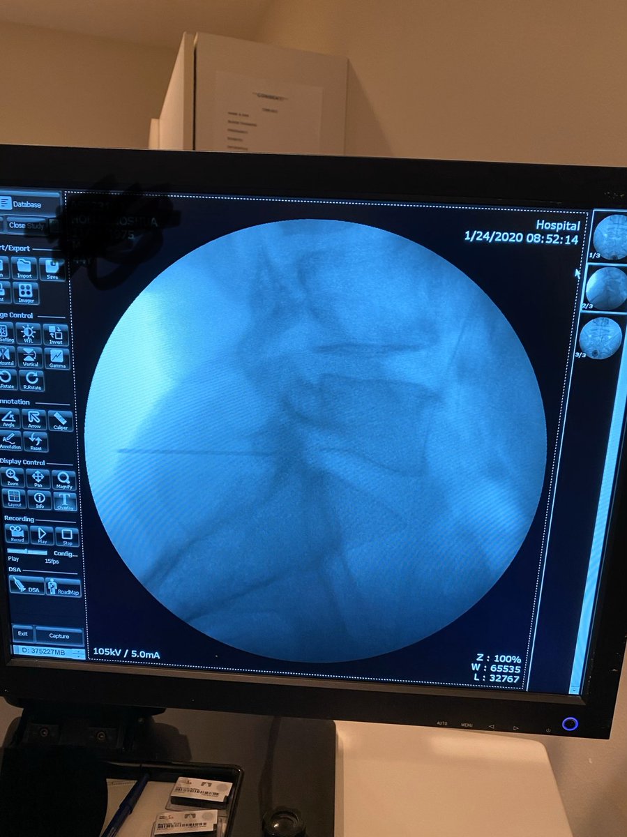 holleyz's tweet image. Epidural for the win!!  #nerveproblems