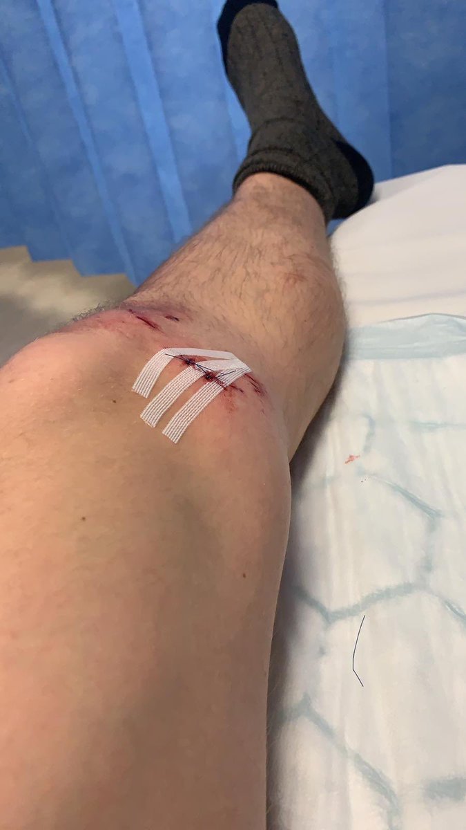 CuddingtonA's tweet photo. @Callum_payne12 all stitched up after today’s horror tackle from the Styal Keeper, atleast he managed to score though #itsonlyascratch https://t.co/plSKr3LFS4