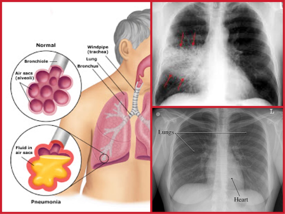 DrBeniRusani's tweet image. Pneumonia is caused by infection like #CoronavirusOutbreak. Our immune system reacts to the virus by creating cytokine-storm. We can’t breathe as our lung air sacs filled with fluid making us ‘drowning’ inside. 

Taking shower at night doesn’t cause pneumonia.