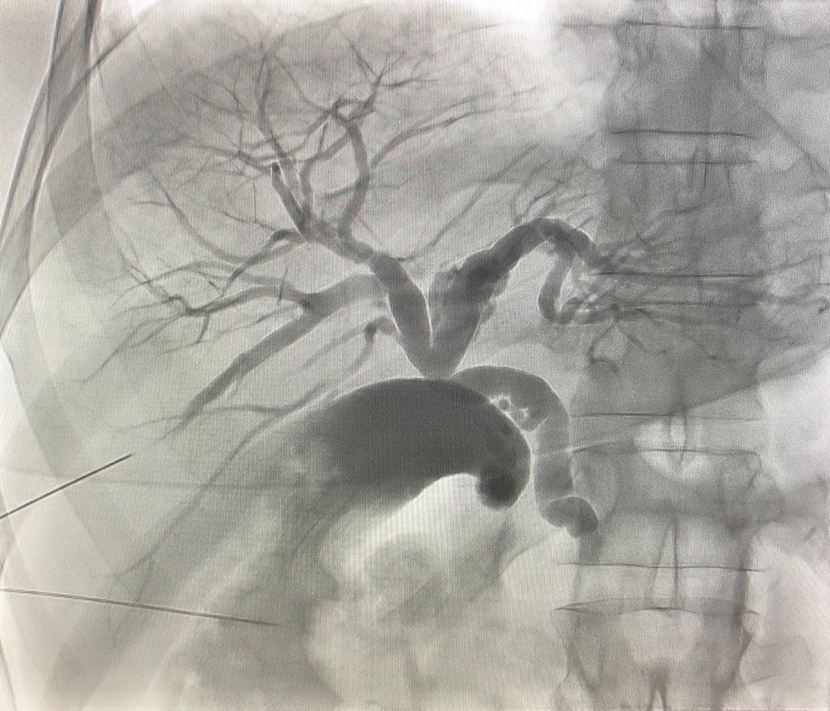 pparmetIR's tweet photo. 64 yo pt with painless obstructive jaundice (total bili 14, direct 12). ERCP failed CBD cannulation, but bile ducts minimally dilated on CT. 

When available, gallbladder stick for PTC can make an otherwise challenging case much easier.  #SmarterNotHarder #IRad @SIR_ECS @SIRRFS https://t.co/zfNmn6jJMX