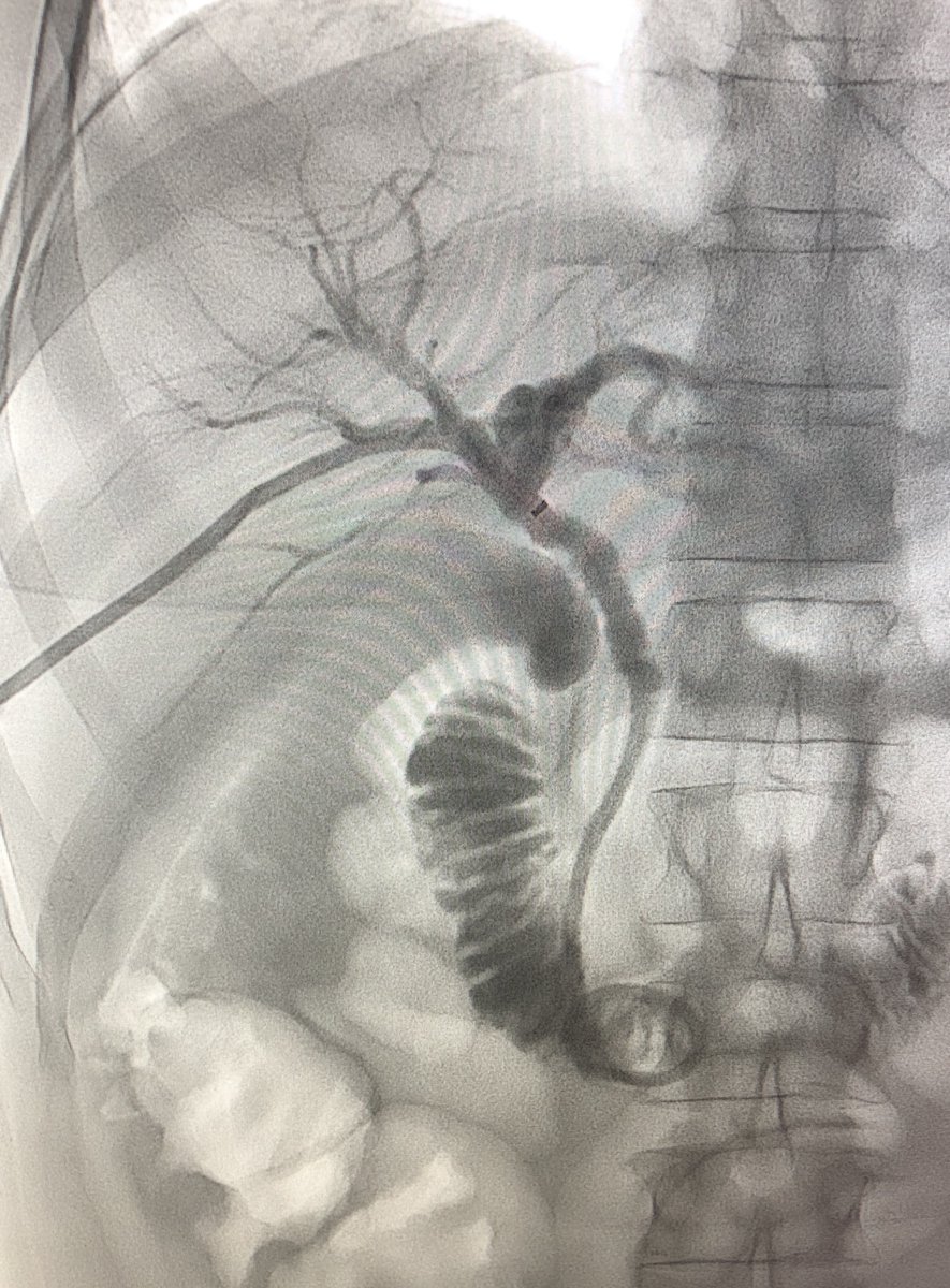 pparmetIR's tweet photo. 64 yo pt with painless obstructive jaundice (total bili 14, direct 12). ERCP failed CBD cannulation, but bile ducts minimally dilated on CT. 

When available, gallbladder stick for PTC can make an otherwise challenging case much easier.  #SmarterNotHarder #IRad @SIR_ECS @SIRRFS https://t.co/zfNmn6jJMX