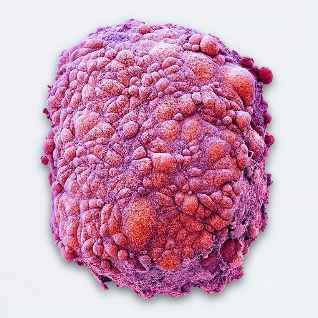 ImgenesMicrosc1's tweet photo. Microfotografía obtenida con un microscopio electrónico de una célula de un mesotelioma, una forma de #cáncer.

El mesotelioma es un cáncer maligno de la pleura, la membrana que recubre la cavidad torácica y los pulmones. Generalmente es causado por la exposición al asbesto. https://t.co/doswpkp51G