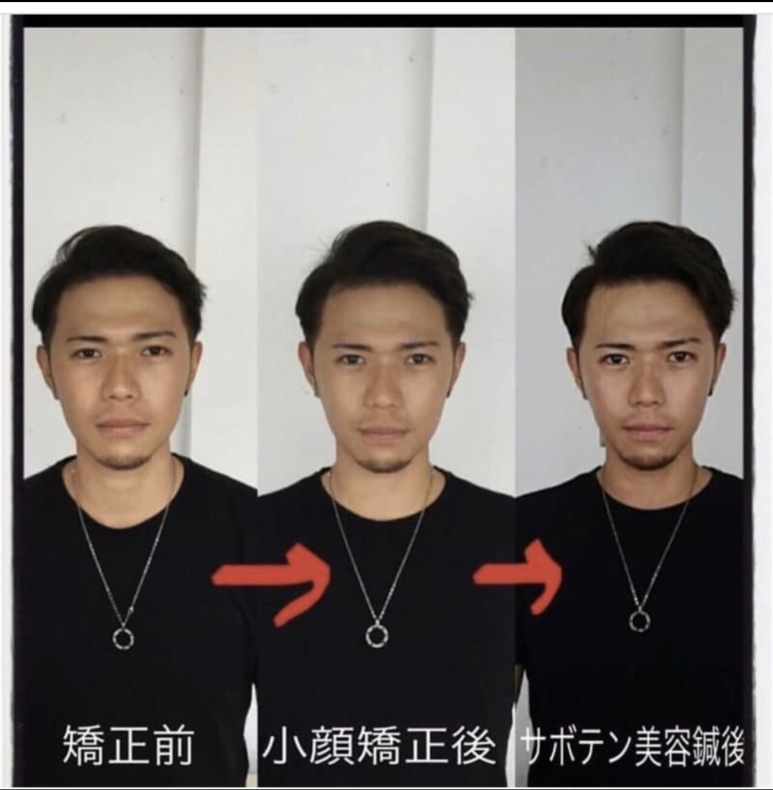 ミナミのオアシス على تويتر 小顔プレミアム 小顔になるための最強メニューです 是非ご体験下さい 小顔 美容鍼 脱毛 ハイフ