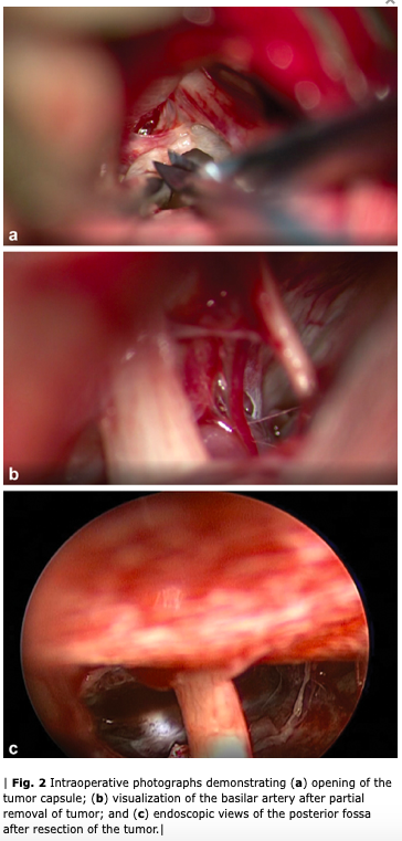 NASBSorg's tweet photo. #nsgy #OpVid from @UVAneurosurg demonstrating the resection of a posterior fossa #epidermoid cyst #education #approaches #skullbasics https://t.co/TrRHjwkXcj https://t.co/38lBSJRkVG