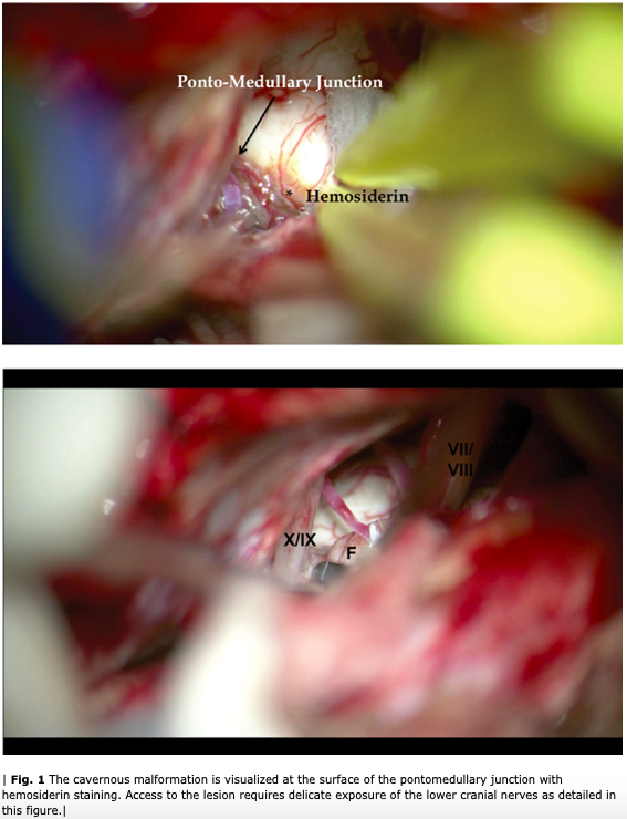 NASBSorg's tweet photo. #nsgy #OpVid from #Tennessee demonstrating resection of pontomedullary junction #cavmal with extended retrosigmoid approach #cerebrovascular #education #approaches #skullbasics https://t.co/Hw3pjTYgEo https://t.co/hct435x4Yr