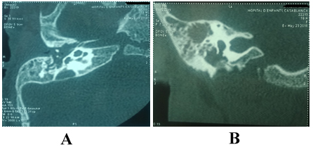 #Auricular Myiasis In Children: Case Report Of Unexpected Foreign Bodie
heraldopenaccess.us/openaccess/aur…