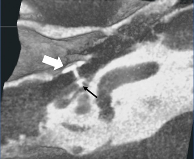 3-D Stereoscopic Display Of High Resolution #FlatPanel Computed Tomography #TemporalBone Imaging
heraldopenaccess.us/openaccess/3-d…