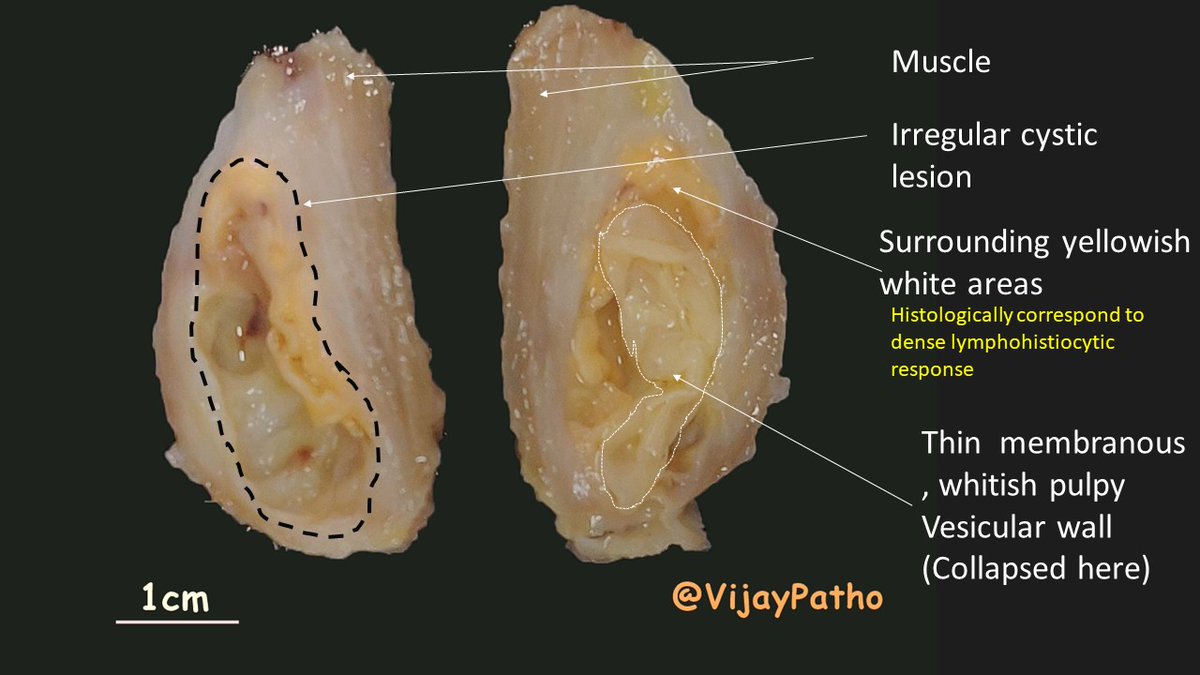 VijayPatho's tweet photo. @DrAhmedKalebi @TheKarenPinto @kriyer68 @vi_monappa @Thejaspatho @luishcruzc @DrGeeONE @pathridle_susan @smlungpathguy @ParasiteGal @DrRolaAli @suraksharaob @tralimiguel @ariella8 @DrFNA @edusqo @lara_pijuan @PrasadCsbr @Path_Matt @DrSamreenfatima @Swathiprabhu5 @adi_agnihotri FINAL DIAGNOSIS : CYSTICERCOSIS. This was within the muscle. Find the images below. @DrAhmedKalebi @TheKarenPinto #grossognosis #pathbugs #pathology #crittersontwitter @vi_monappa @luishcruzc #pathology #pathboards @smlungpathguy https://t.co/NwDfOxr7xI