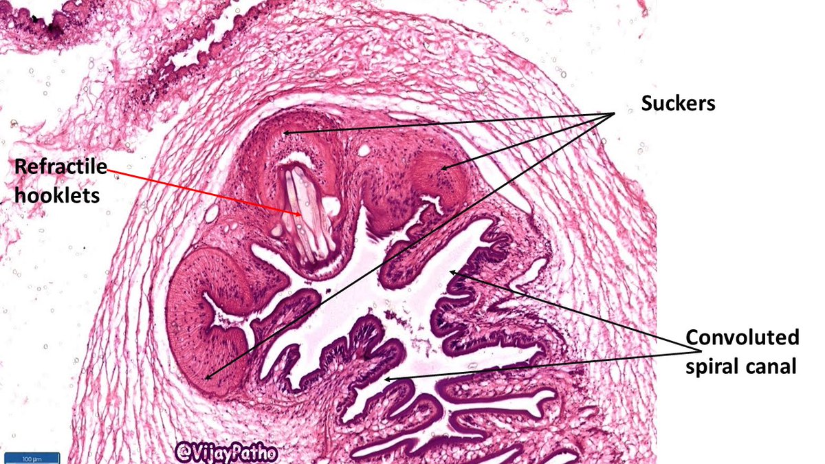 VijayPatho's tweet photo. @DrAhmedKalebi @TheKarenPinto @kriyer68 @vi_monappa @Thejaspatho @luishcruzc @DrGeeONE @pathridle_susan @smlungpathguy @ParasiteGal @DrRolaAli @suraksharaob @tralimiguel @ariella8 @DrFNA @edusqo @lara_pijuan @PrasadCsbr @Path_Matt @DrSamreenfatima @Swathiprabhu5 @adi_agnihotri FINAL DIAGNOSIS : CYSTICERCOSIS. This was within the muscle. Find the images below. @DrAhmedKalebi @TheKarenPinto #grossognosis #pathbugs #pathology #crittersontwitter @vi_monappa @luishcruzc #pathology #pathboards @smlungpathguy https://t.co/NwDfOxr7xI