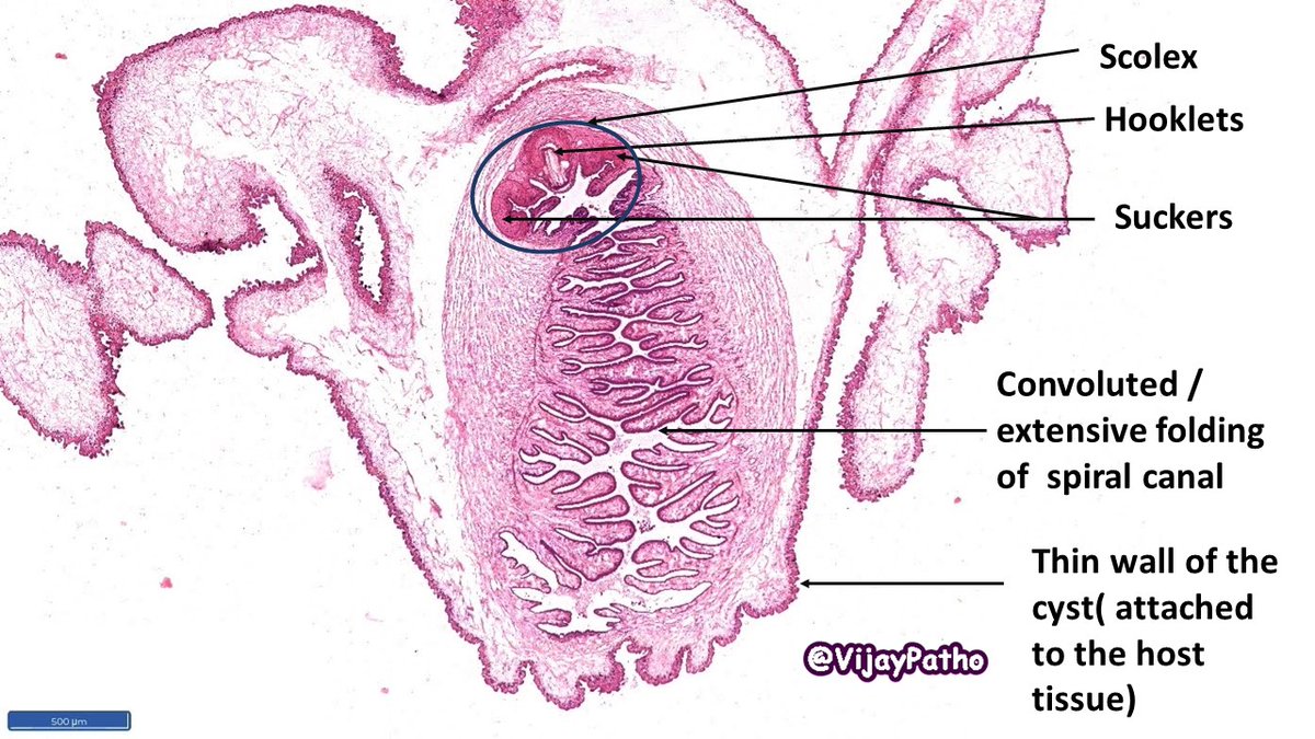 VijayPatho's tweet photo. @DrAhmedKalebi @TheKarenPinto @kriyer68 @vi_monappa @Thejaspatho @luishcruzc @DrGeeONE @pathridle_susan @smlungpathguy @ParasiteGal @DrRolaAli @suraksharaob @tralimiguel @ariella8 @DrFNA @edusqo @lara_pijuan @PrasadCsbr @Path_Matt @DrSamreenfatima @Swathiprabhu5 @adi_agnihotri FINAL DIAGNOSIS : CYSTICERCOSIS. This was within the muscle. Find the images below. @DrAhmedKalebi @TheKarenPinto #grossognosis #pathbugs #pathology #crittersontwitter @vi_monappa @luishcruzc #pathology #pathboards @smlungpathguy https://t.co/NwDfOxr7xI